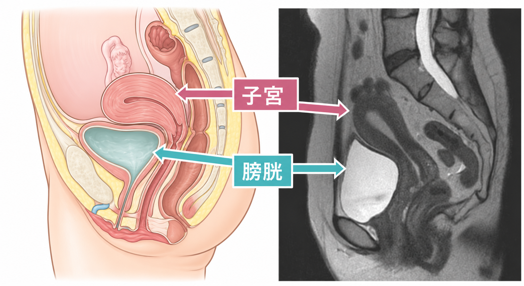 骨盤の解剖図とMRI画像（子宮・膀胱）