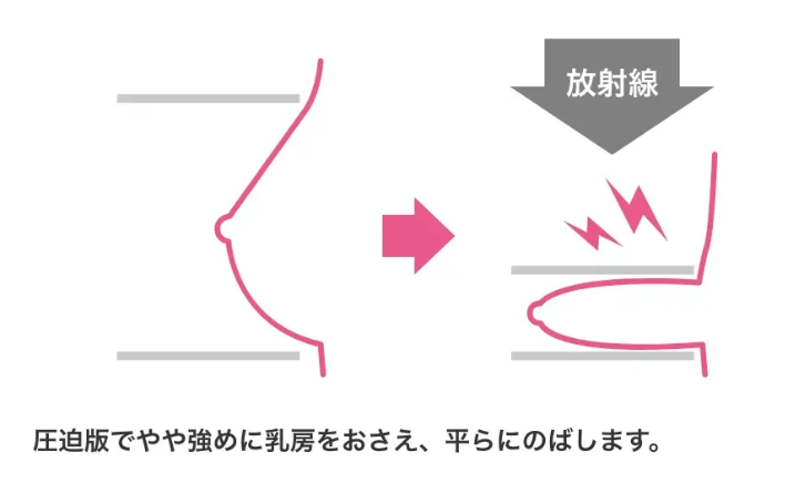 マンモグラフィ検査（圧迫版でやや強めに乳房をおさえ平らにのばす）