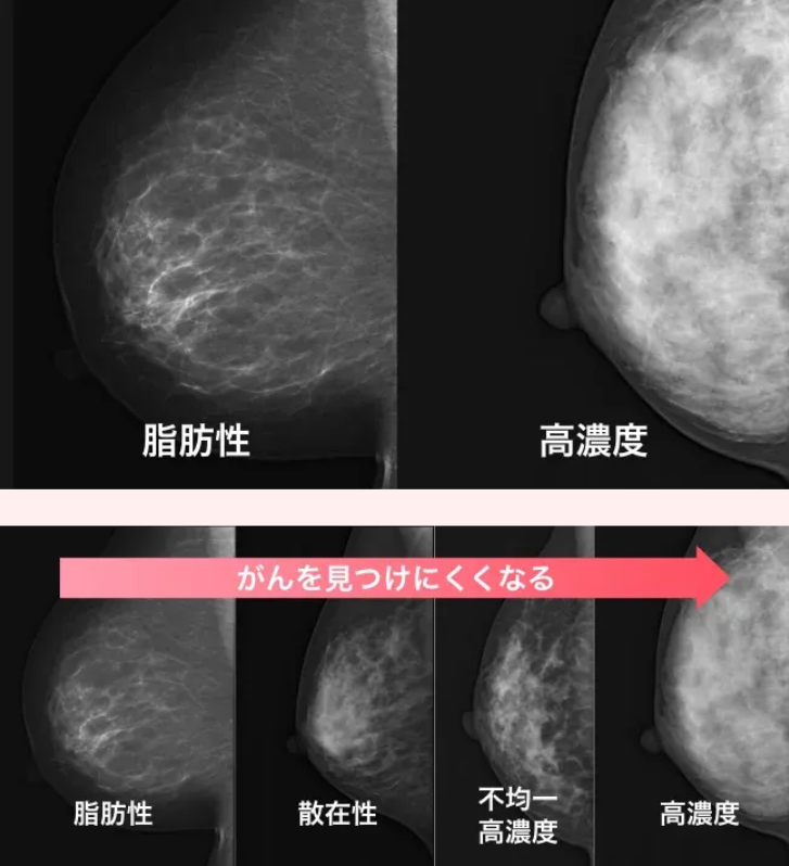 乳房の濃度分類（脂肪性・高濃度）マンモグラフィ画像