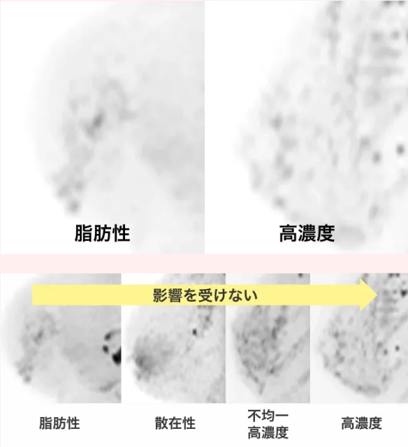 乳房の濃度分類（脂肪性・高濃度）ドゥイブス・サーチ画像（影響を受けない）